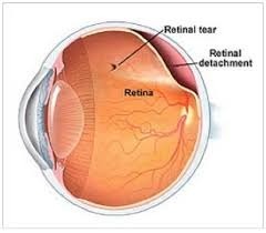 Cross section of eye showing retinal detachment