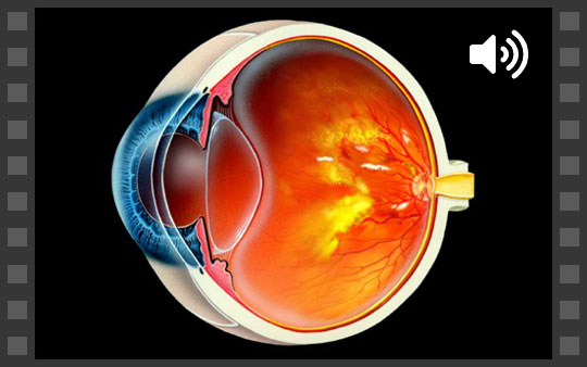 Diabetic retinopathy