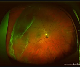 Retinal Tear Optomap