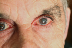 Man with cataract eye